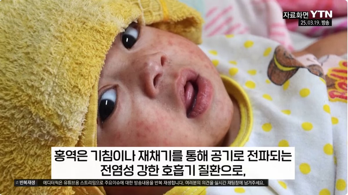 펜실베이니아 홍역 환자 977명… 5번째 사망자 발생, 보건당국 비상